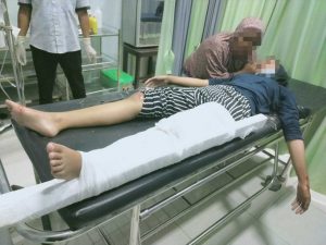 Dijambret saat Main HP di Atas Motor, Gadis Muda Ini Terjatuh dan Kakinya Patah