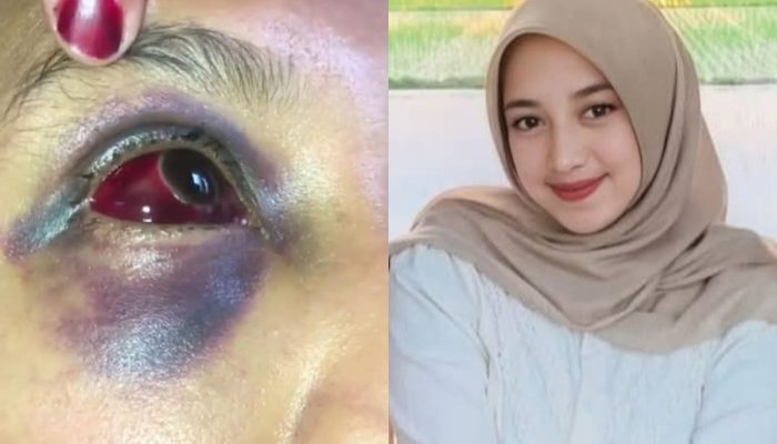 Mama Muda di Bima Dianiaya Suami, Mata Memar dan Hidung Berdarah