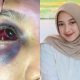 Mama Muda di Bima Dianiaya Suami, Mata Memar dan Hidung Berdarah